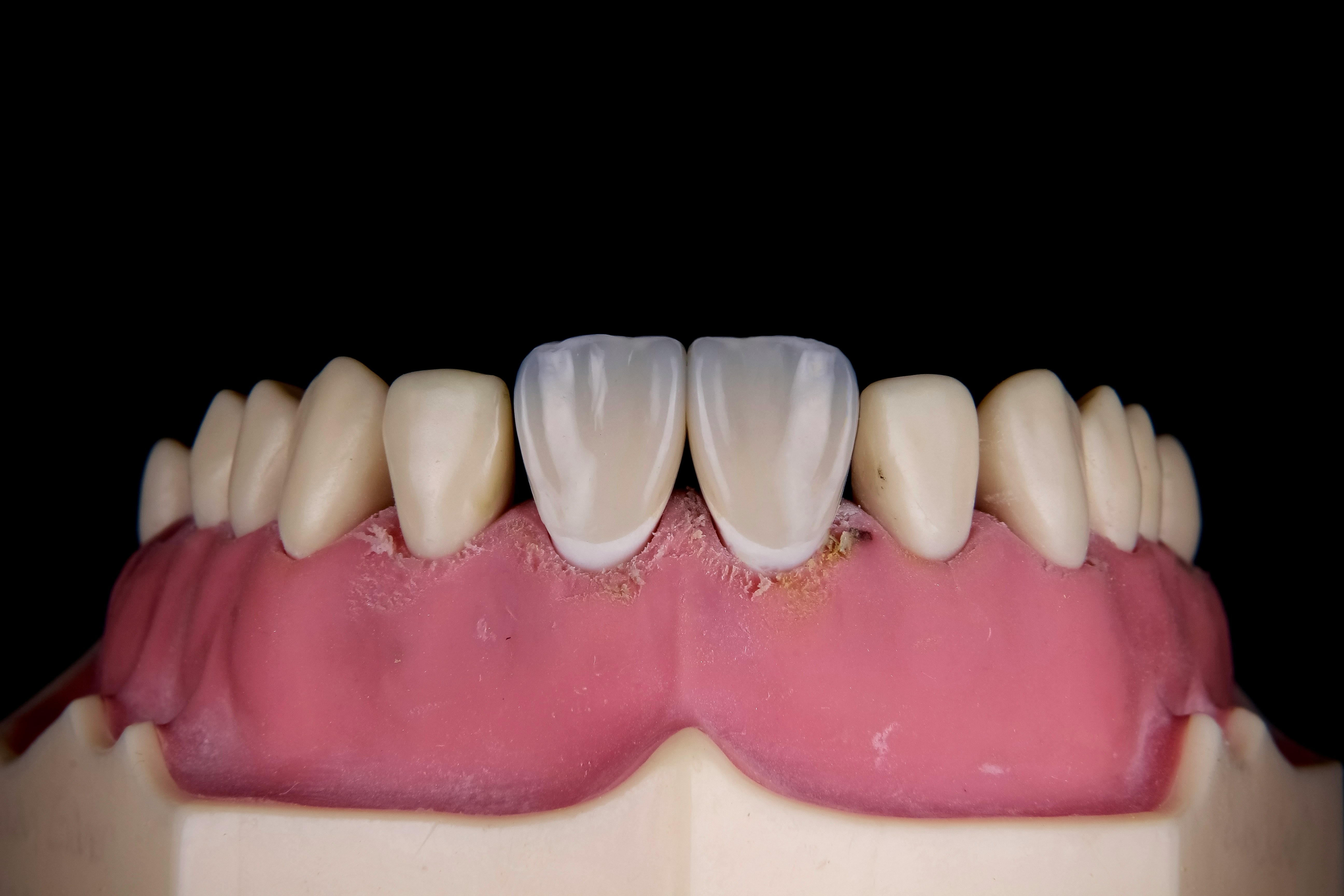 Gum Contouring in Albania: Reshaping the Smile Line