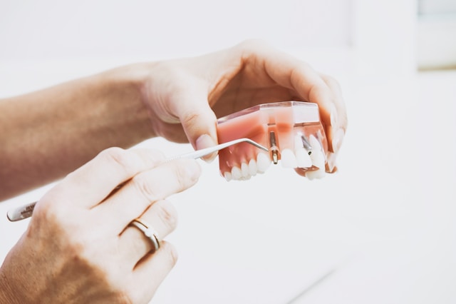 Dental Implants Cost Albania 2026: €400 per Implant — Full Price List